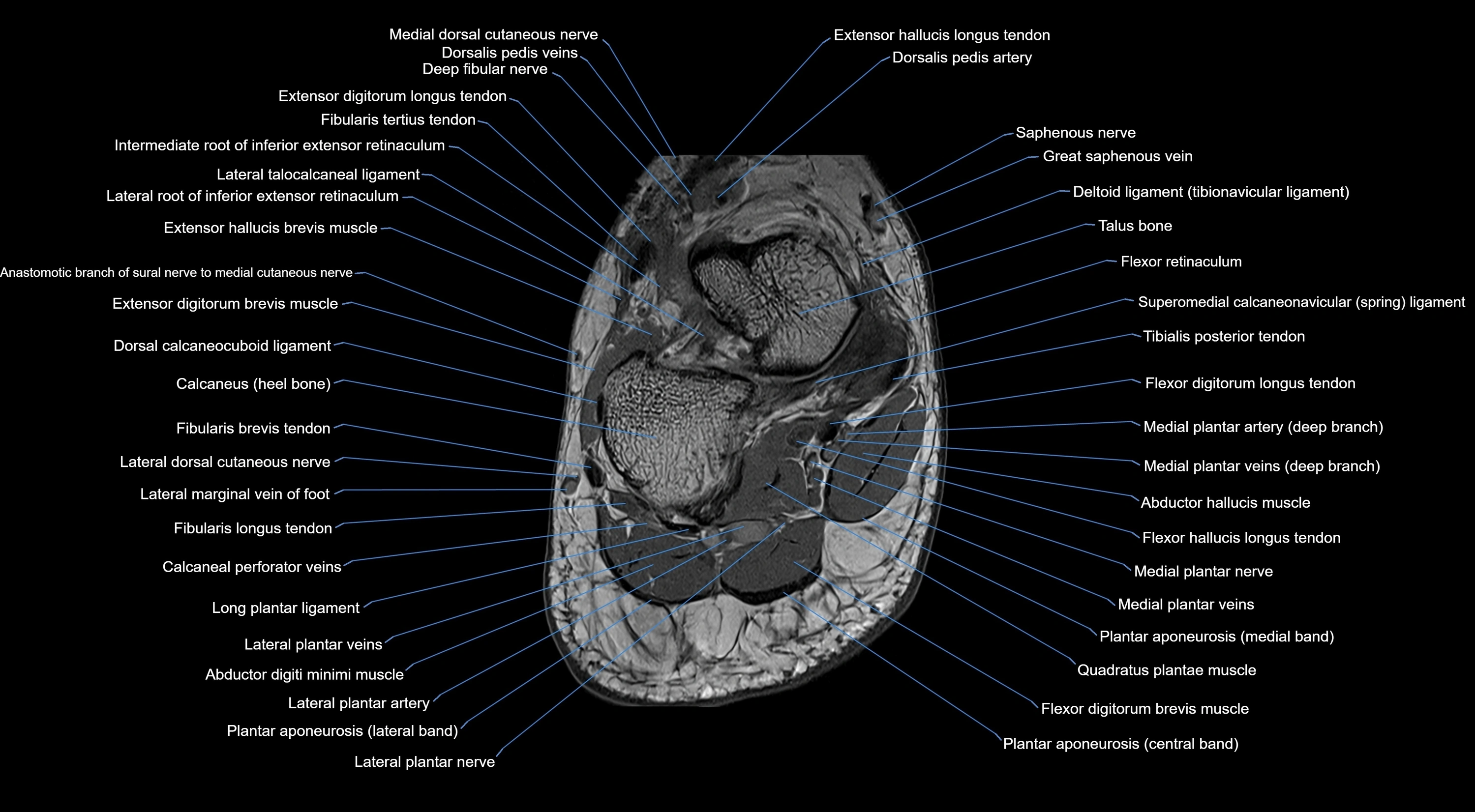 MRI mid foot coronal ligaments cross sectional anatomy 3T  radiology  image-img-00001-00039.webp